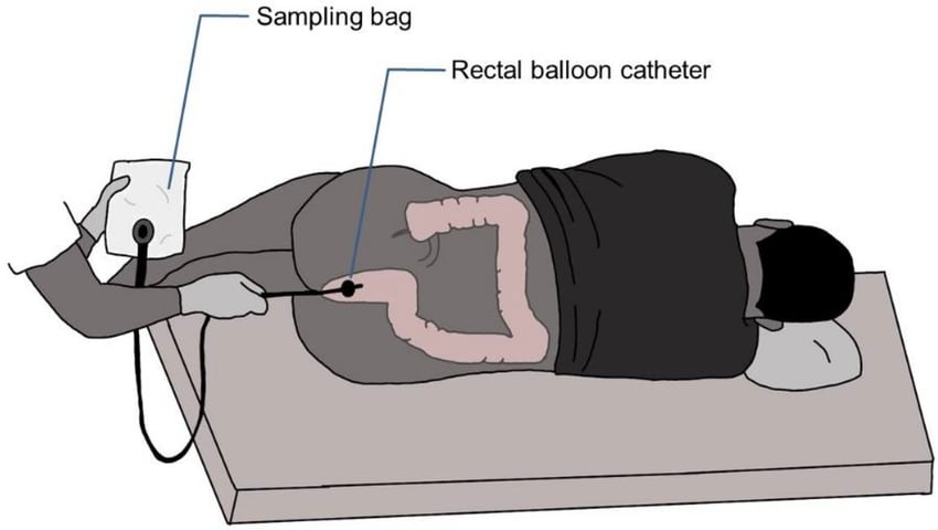 diagram of how to use a rectal balloon catheter